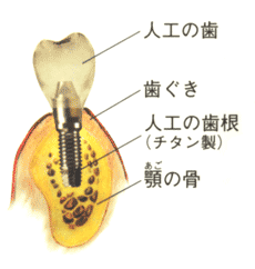 �C���v�����g�Ƃ́H